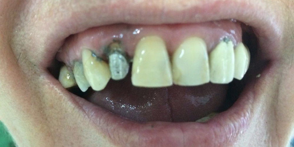  Восстановление эстетики и анатомической целостности зубного ряда верхней челюсти