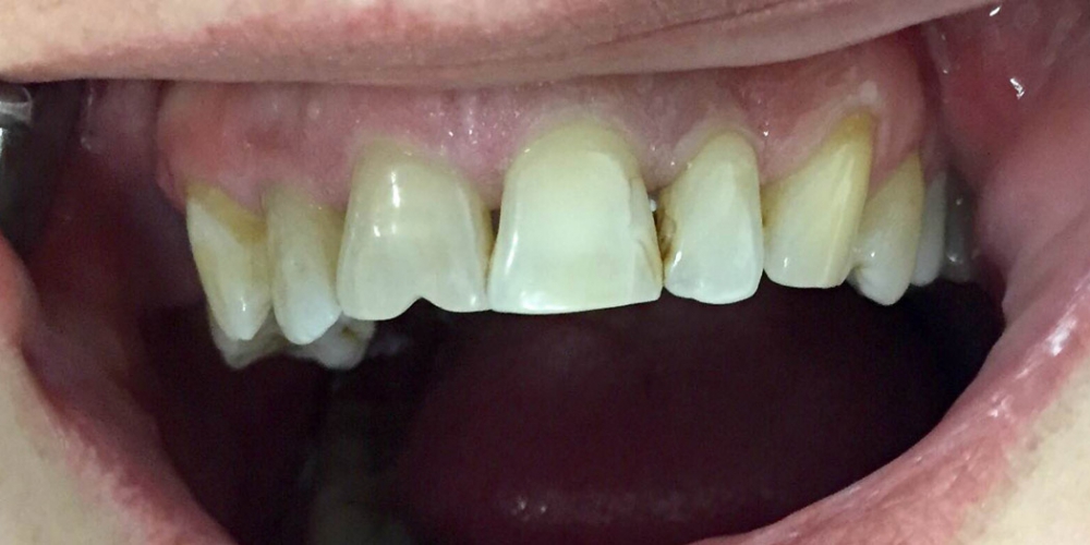  Эстетическая реставрация фронтальной группы зубов верхней челюсти