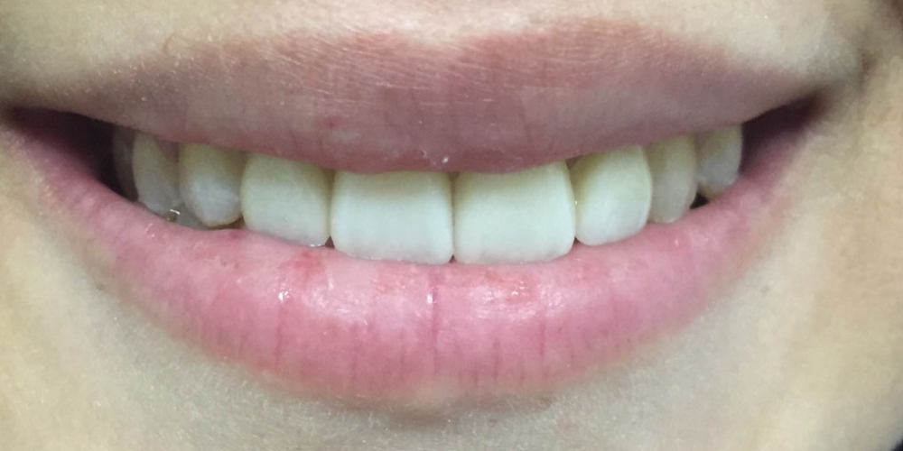  Изготовление керамических (фарфоровых) виниров E-max на фронтальную группу зубов верхней челюсти