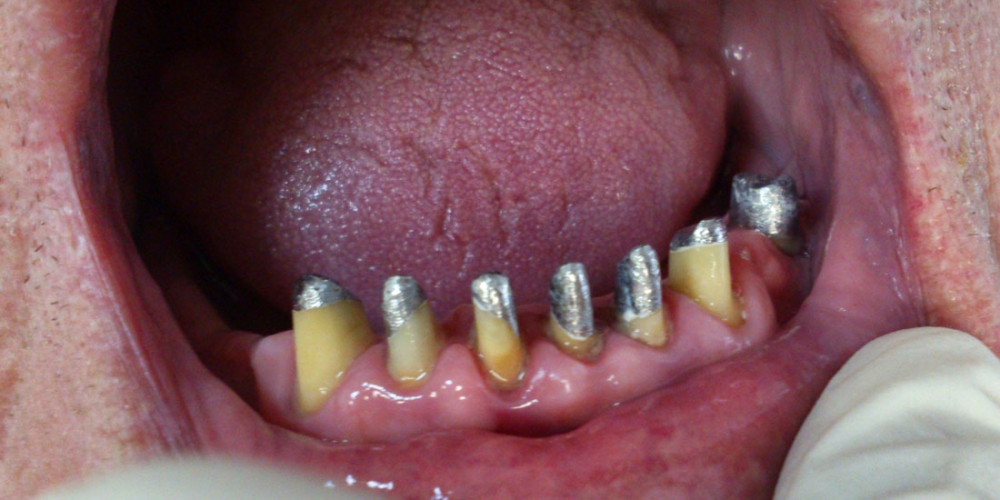  Протезирование при полном отсутствии зубов верхней челюсти и жевательных зубов нижней челюсти