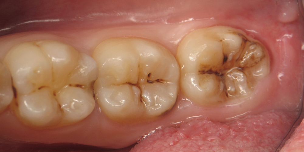  Лечение глубокого кариеса с установкой световой пломбы 3 зубов