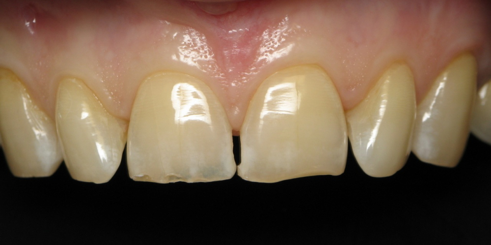  Восстановление режущего края передних зубов