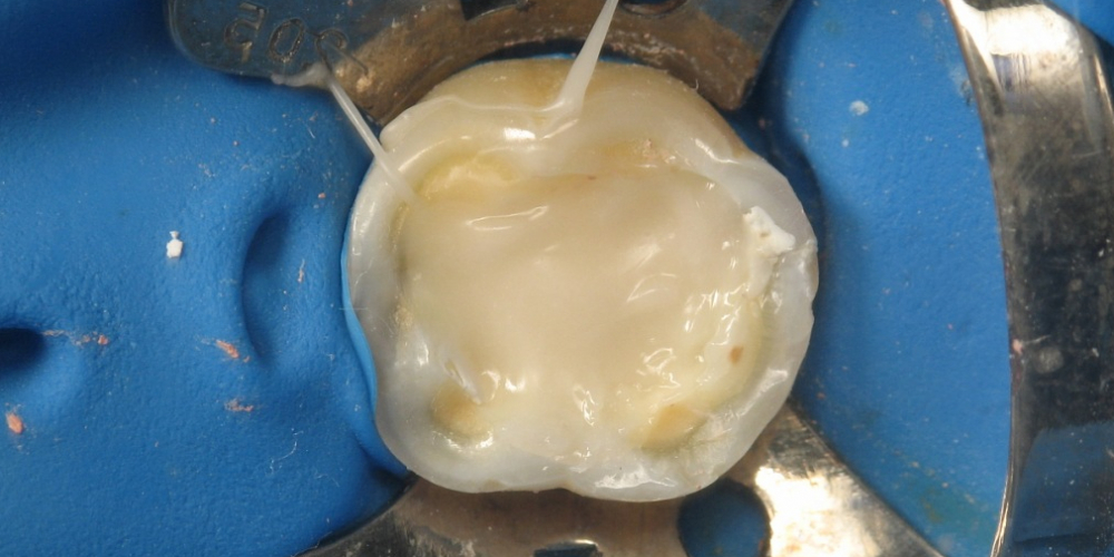  Лечение каналов зуба под микроскопом с наложением пломбы