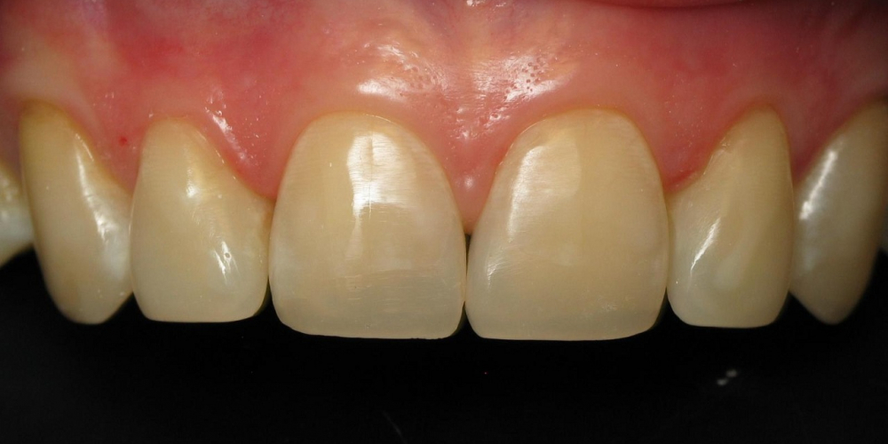  Восстановление скола переднего зуба