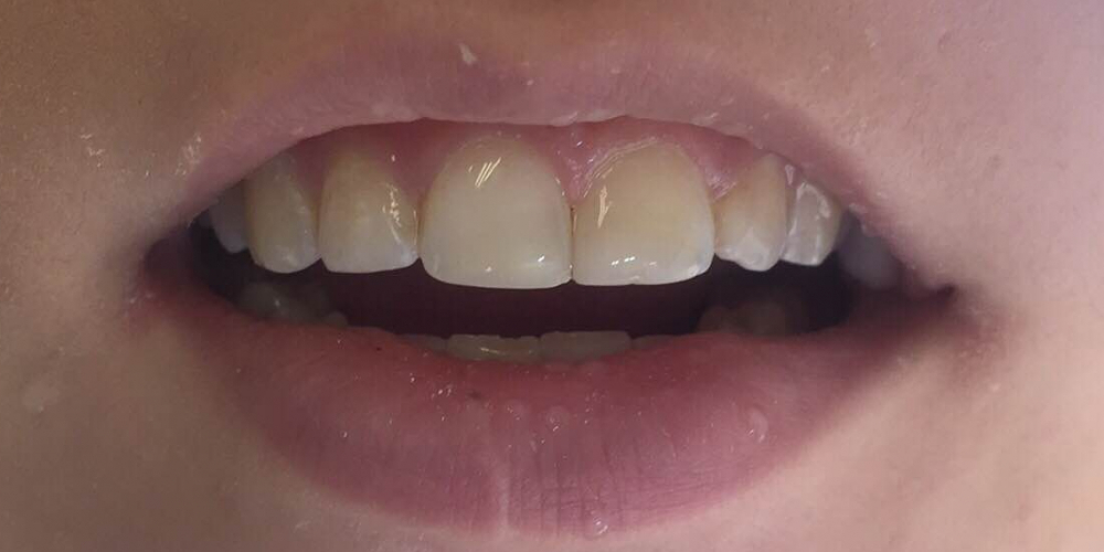  Эстетическое восста­новление скола перед­него зуба