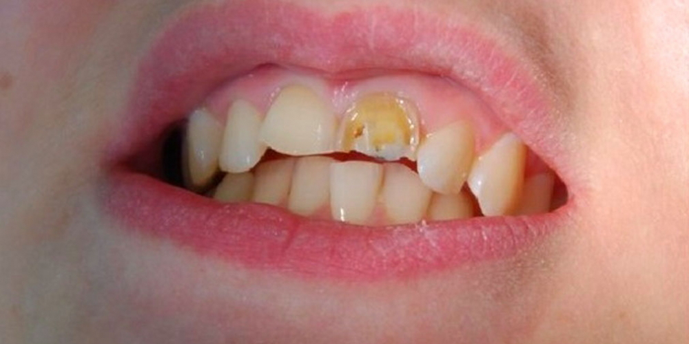  Установка двух безметалловых коронок E Max на 2 передних зуба