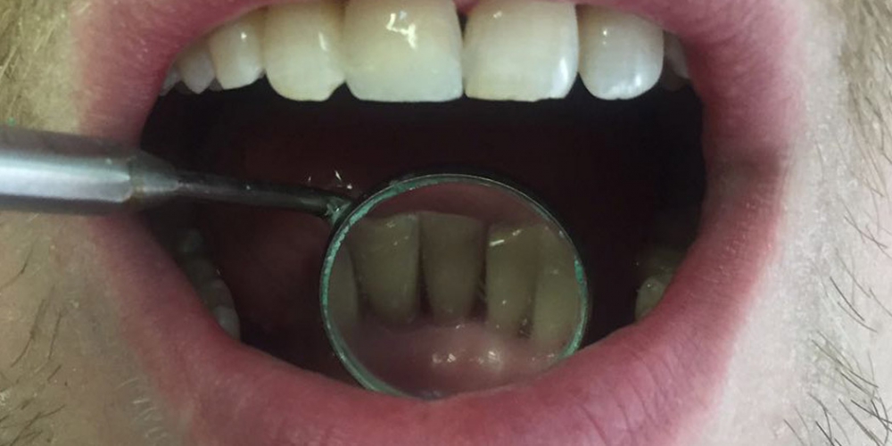  Снятие зубного камня ультразвуковым скалером пр-ва NSK