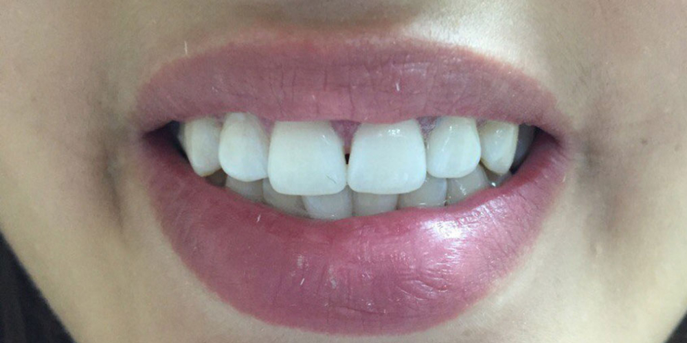  Результат отбеливания зубов системой отбеливания Smileffect у девушки