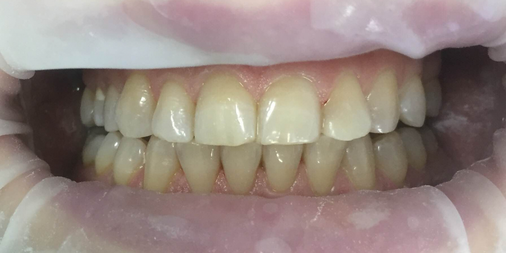  Проведена эстетическая реставрация зуба 2.2, материал Filtek Ultimate