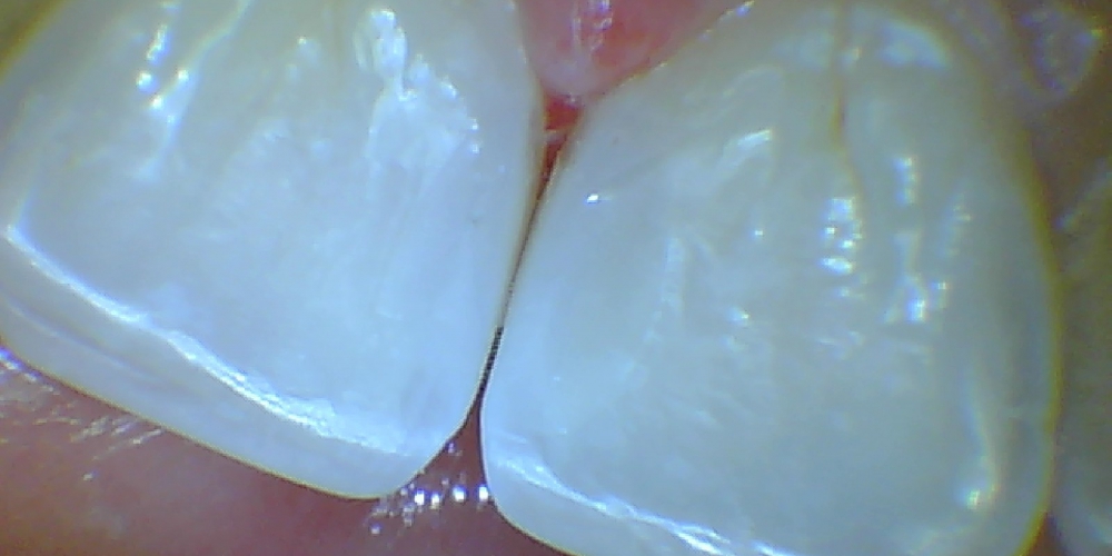 после Лечение среднего кариеса передних зубов