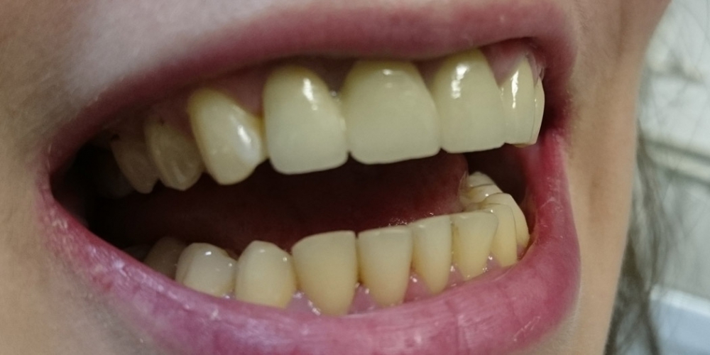  Керамические коронки на основе диоксида циркония (ZrO2) на 4-х фронтальных зубах