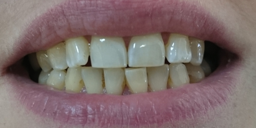  Пришлифовка суперконтактов фронтальных зубов с последующей полировкой