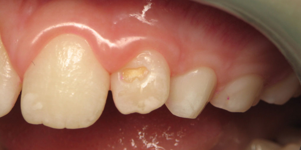  Лечение клиновидного дефекта 2-го центрального зуба