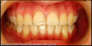 Исправление положения зубов в челюсти с помощью брекет системы фото после лечения