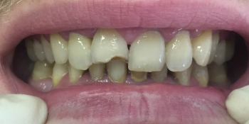 Ремонт сколовшегося переднего зуба фото до лечения