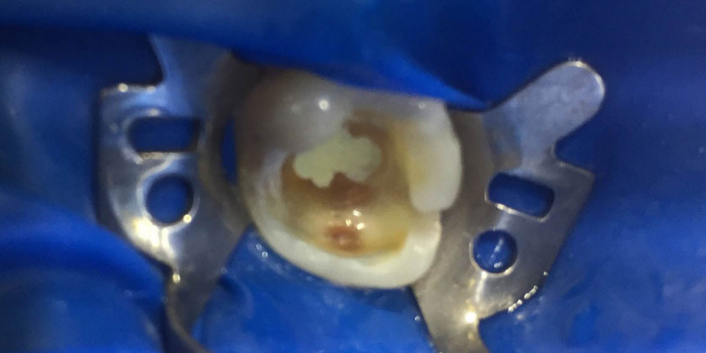  Замена несостоятельной пломбы зуба 1.6, рецидив кариеса