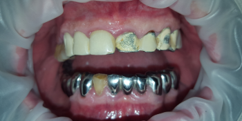 Замена металлопластмассовых мостовидных протезов верней челюсти фото до лечения