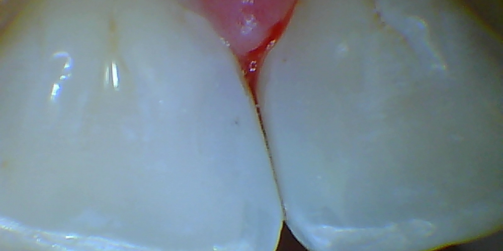  Лечение среднего кариеса передних зубов