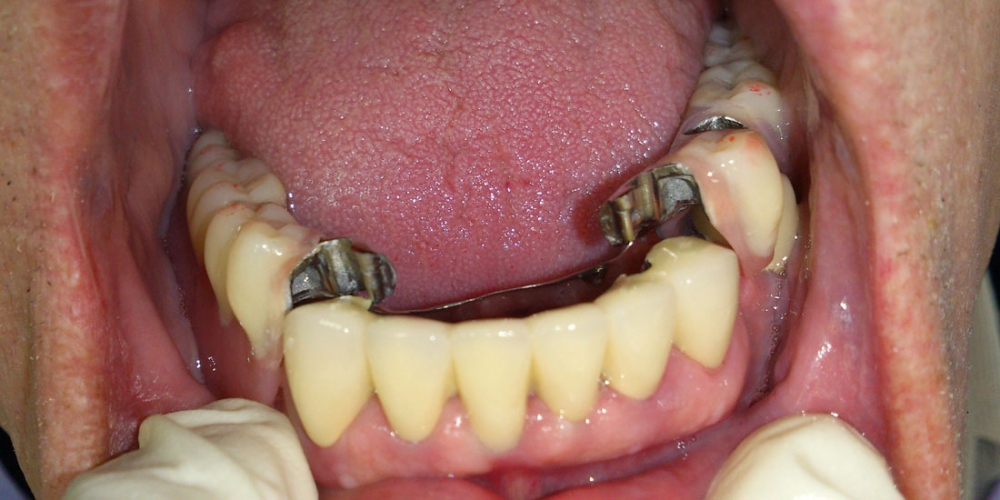  Протезирование при полном отсутствии зубов верхней челюсти и жевательных зубов нижней челюсти