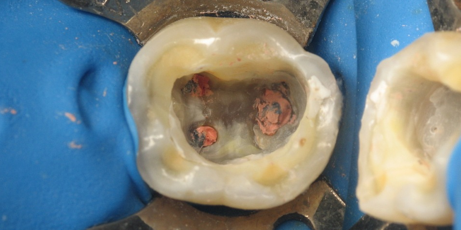  Лечение каналов зуба под микроскопом с наложением пломбы