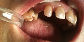 Одномоментное восполнение утраченного зуба с помощью специальной стекловолоконной ленты фото до лечения