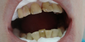 Эстетическая реставрация фронтальной группы зубов верхней челюсти фото до лечения