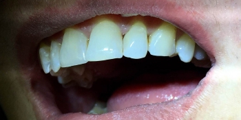 Эстетическая реставрация фронтальной группы зубов верхней челюсти фото после лечения