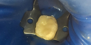 Лечение острого пульпита зуба 3.6 в одно посещение фото после лечения