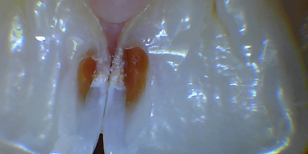 вид с небной стороны после снятия эмалевой "крыши" Лечение среднего кариеса передних зубов