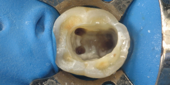 Лечение каналов зуба под микроскопом с наложением пломбы фото до лечения