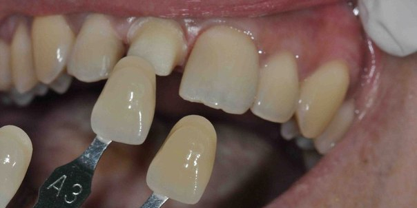  Восстановление передних зубов из композитного материала и безметалловой коронки