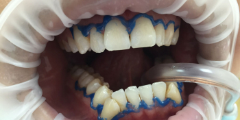Отбеливание зубов системой Smileffect фото до лечения