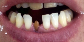 Ревставрация зубов коронкой E-MAX фото до лечения