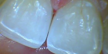 Лечение среднего кариеса передних зубов фото после лечения