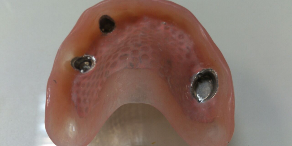 Результат протезирования Бюгельный протез верхней челюсти с фиксацией на телескопические коронки