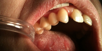 Одномоментное восполнение утраченного зуба с помощью специальной стекловолоконной ленты фото после лечения