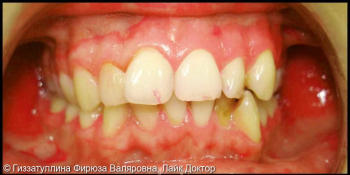 Исправление положения зубов в челюсти с помощью брекет системы фото до лечения